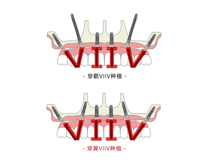 VIIV穿颧穿翼